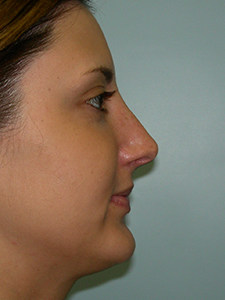Rhinoplasty Before and After Pictures Miami, FL