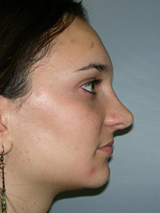 Rhinoplasty Before and After Pictures Miami, FL