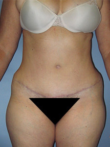 Tummy Tuck Before and After Pictures Miami, FL