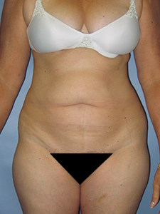 Tummy Tuck Before and After Pictures Miami, FL