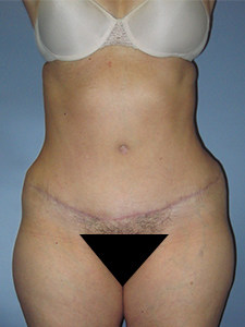 Tummy Tuck Before and After Pictures Miami, FL