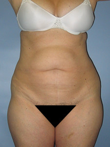 Tummy Tuck Before and After Pictures Miami, FL