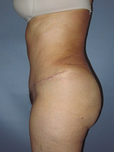 Tummy Tuck Before and After Pictures Miami, FL