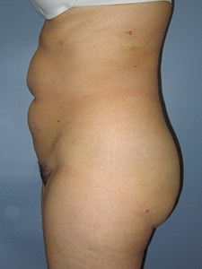 Tummy Tuck Before and After Pictures Miami, FL