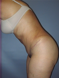 Tummy Tuck Before and After Pictures Miami, FL