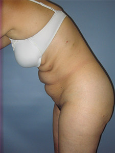 Tummy Tuck Before and After Pictures Miami, FL