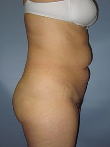 Tummy Tuck Before and After Pictures Miami, FL