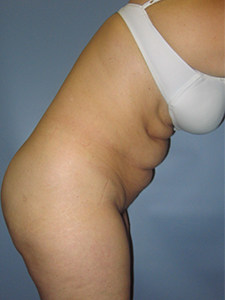 Tummy Tuck Before and After Pictures Miami, FL