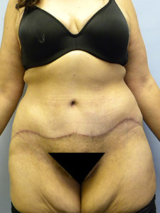 Tummy Tuck Before and After Pictures Miami, FL