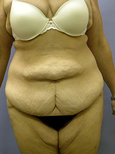 Tummy Tuck Before and After Pictures Miami, FL