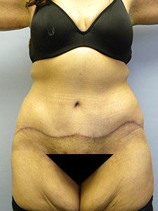 Tummy Tuck Before and After Pictures Miami, FL