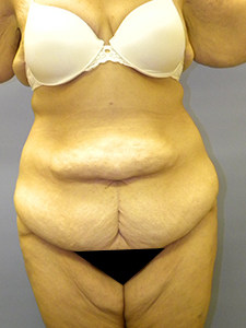 Tummy Tuck Before and After Pictures Miami, FL