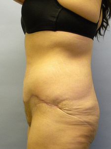 Tummy Tuck Before and After Pictures Miami, FL