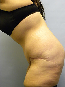 Tummy Tuck Before and After Pictures Miami, FL