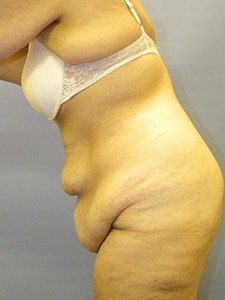 Tummy Tuck Before and After Pictures Miami, FL