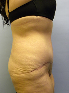 Tummy Tuck Before and After Pictures Miami, FL