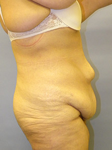 Tummy Tuck Before and After Pictures Miami, FL