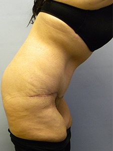 Tummy Tuck Before and After Pictures Miami, FL