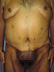 Tummy Tuck Before and After Pictures Miami, FL