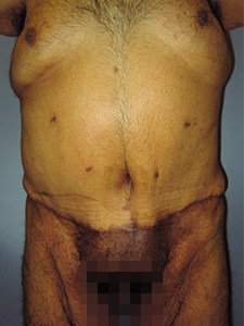 Tummy Tuck Before and After Pictures Miami, FL