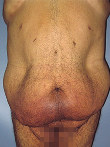 Tummy Tuck Before and After Pictures Miami, FL