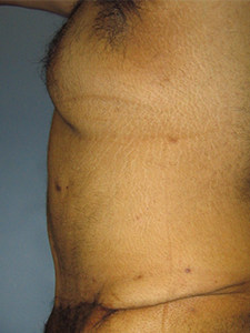 Tummy Tuck Before and After Pictures Miami, FL