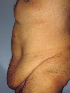 Tummy Tuck Before and After Pictures Miami, FL