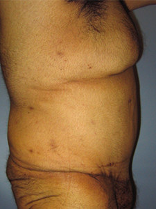 Tummy Tuck Before and After Pictures Miami, FL