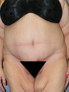 Tummy Tuck Before and After Pictures Miami, FL