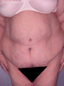 Tummy Tuck Before and After Pictures Miami, FL