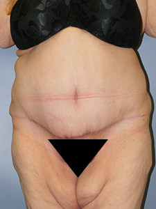 Tummy Tuck Before and After Pictures Miami, FL