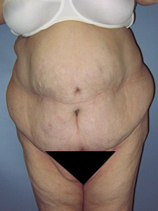 Tummy Tuck Before and After Pictures Miami, FL