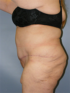 Tummy Tuck Before and After Pictures Miami, FL