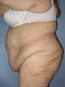 Tummy Tuck Before and After Pictures Miami, FL