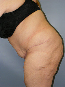 Tummy Tuck Before and After Pictures Miami, FL