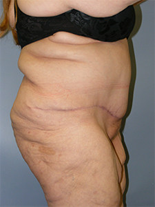 Tummy Tuck Before and After Pictures Miami, FL