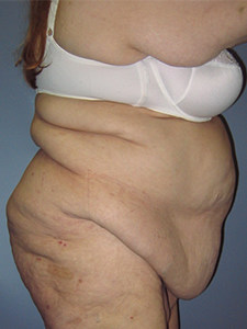 Tummy Tuck Before and After Pictures Miami, FL