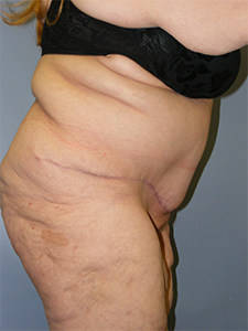 Tummy Tuck Before and After Pictures Miami, FL