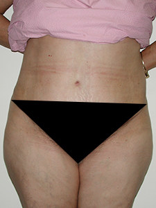 Tummy Tuck Before and After Pictures Miami, FL