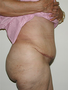 Tummy Tuck Before and After Pictures Miami, FL