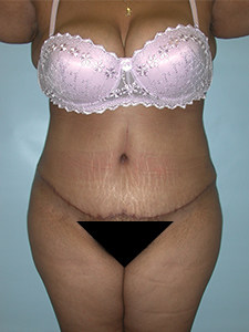 Tummy Tuck Before and After Pictures Miami, FL