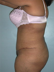 Tummy Tuck Before and After Pictures Miami, FL