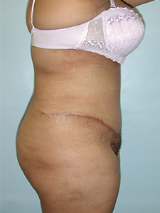 Tummy Tuck Before and After Pictures Miami, FL