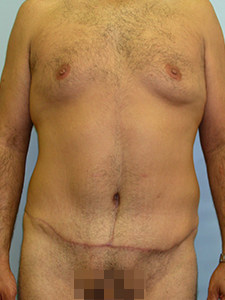 Tummy Tuck Before and After Pictures Miami, FL