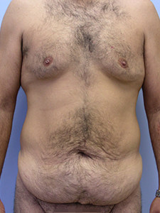 Tummy Tuck Before and After Pictures Miami, FL