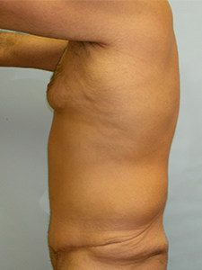 Tummy Tuck Before and After Pictures Miami, FL