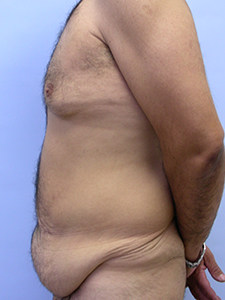 Tummy Tuck Before and After Pictures Miami, FL