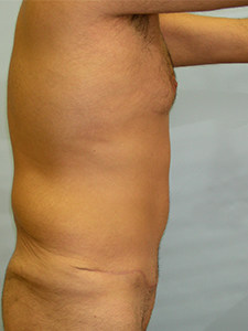 Tummy Tuck Before and After Pictures Miami, FL