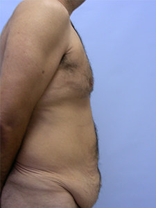 Tummy Tuck Before and After Pictures Miami, FL