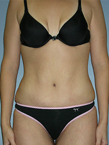 Tummy Tuck Before and After Pictures Miami, FL